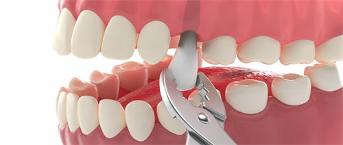 2023年凉山州会理县牙齿美白胶的价格受那些因素的影响-牙齿美白胶大概要价格多少?