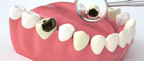 2023年西双版纳种植牙修复牙缝宽大整形医生在哪里