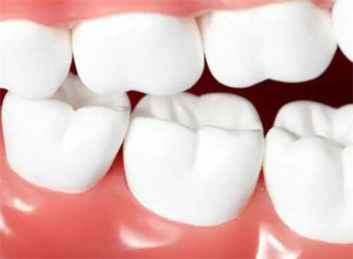 桂林市秀峰区传统金属托槽牙齿矫正价格项目明细在线在线公开「传统金属托槽牙齿矫正费用受什么因素影响」