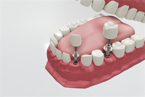 2023年福州市永泰县传统金属托槽牙齿矫正整形医生排名新