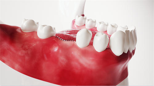 2023年重庆市南川区诺贝尔PMC种植牙精品整形医生!重庆市南川区诺贝尔PMC种植牙整形医生技术?