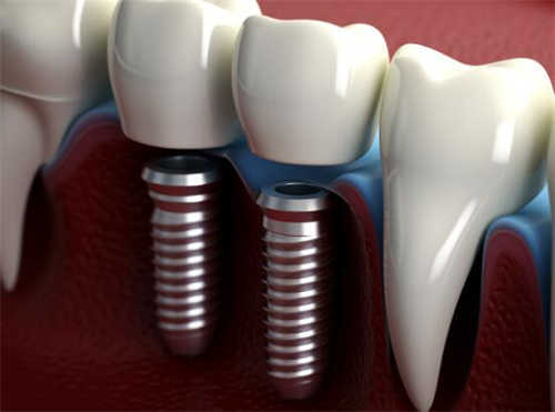 防城港市上思种植牙齿术的二甲医院医生有哪些2024年